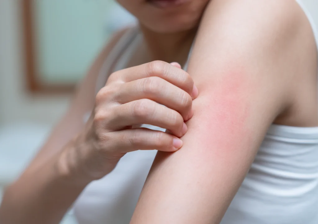 Part of a Woman's Hand is Red Due to a Skin Problem