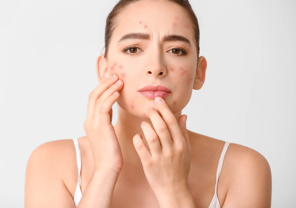 Effective Period Acne Treatment to Help You Feel Confident