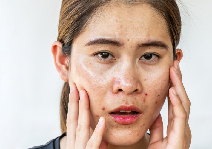 Young Woman Looks Worried with her Skin