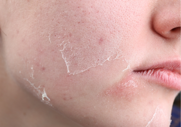 Dried Face Skin Close up